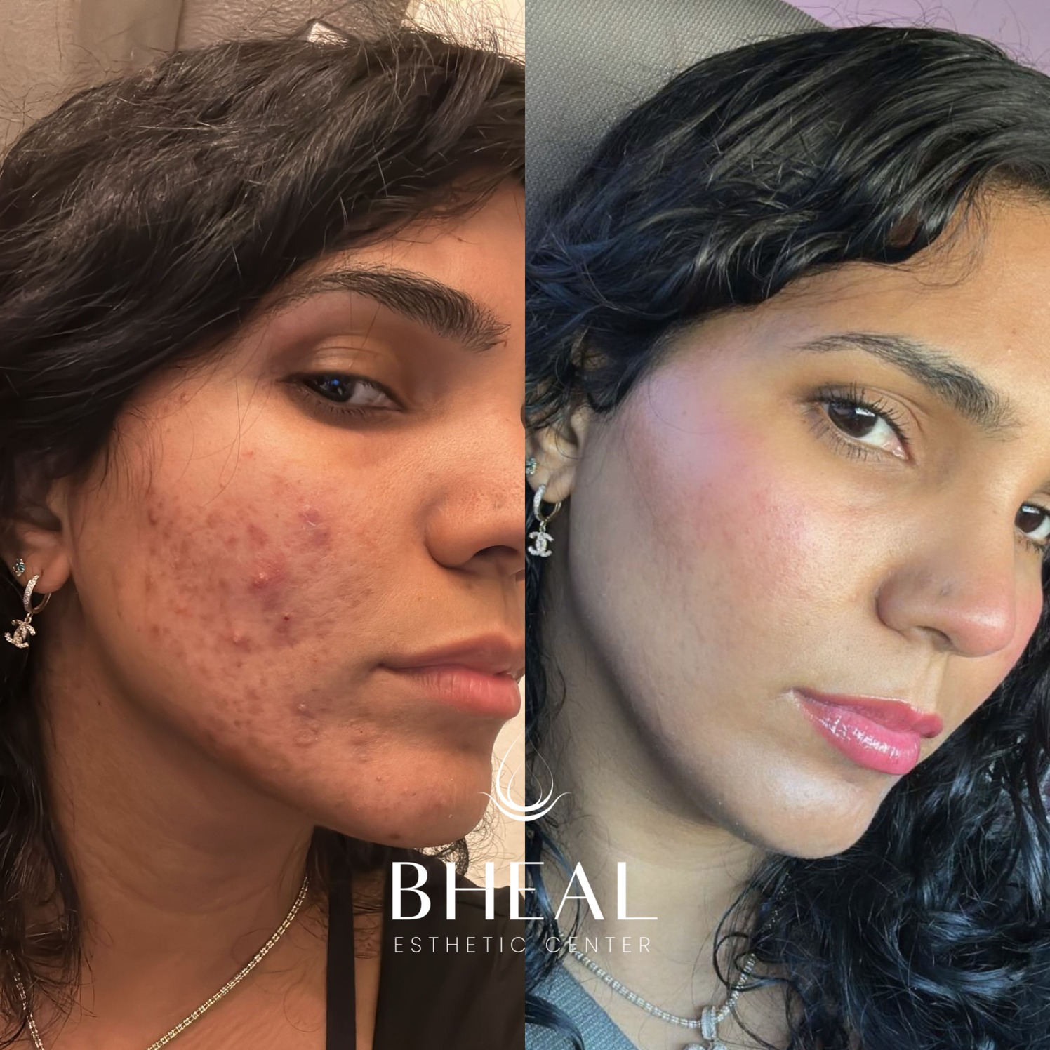 bheal-acne-clear-1