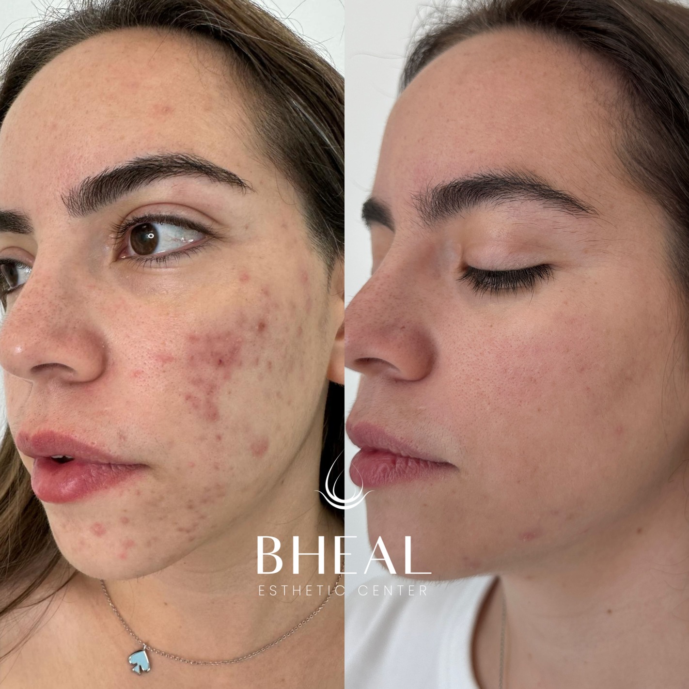 bheal-acne-clear-2