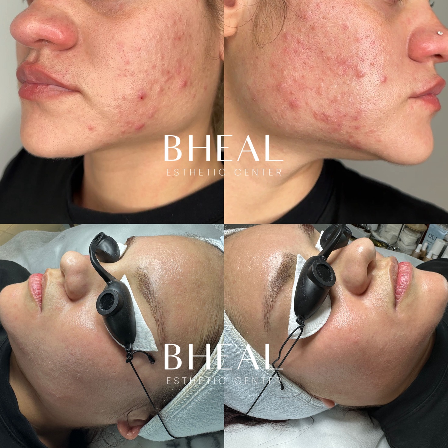 bheal-acne-clear-3