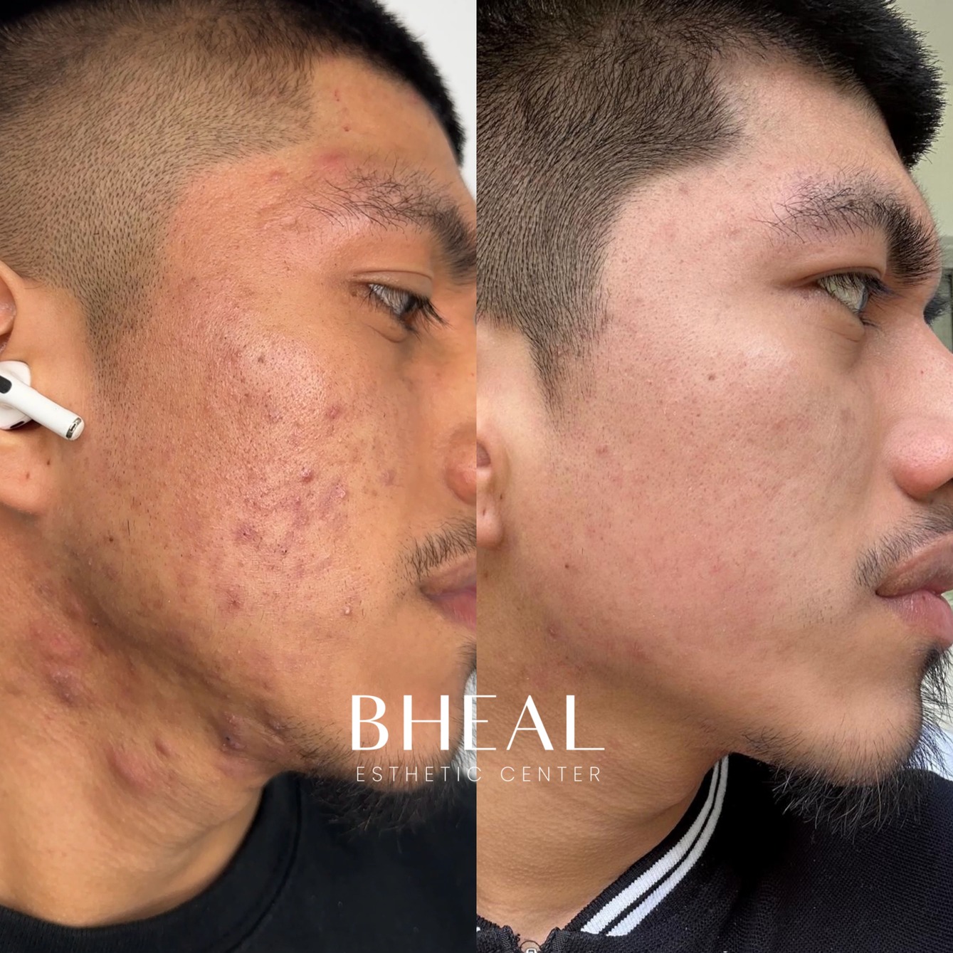 bheal-acne-clear-4