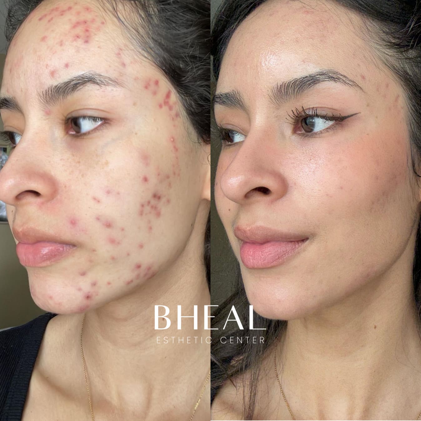 cicatrices-microneedling-1