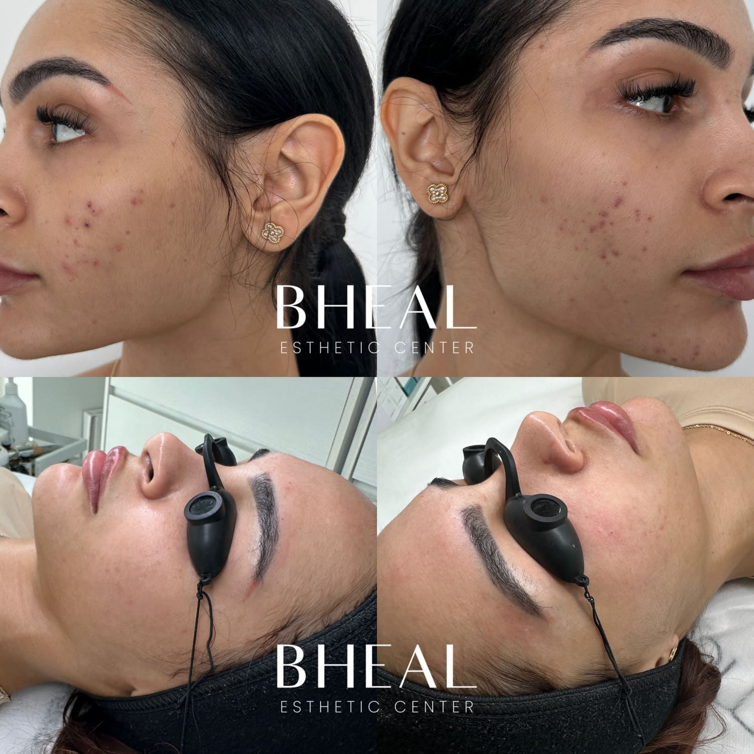 cicatrices-microneedling-4