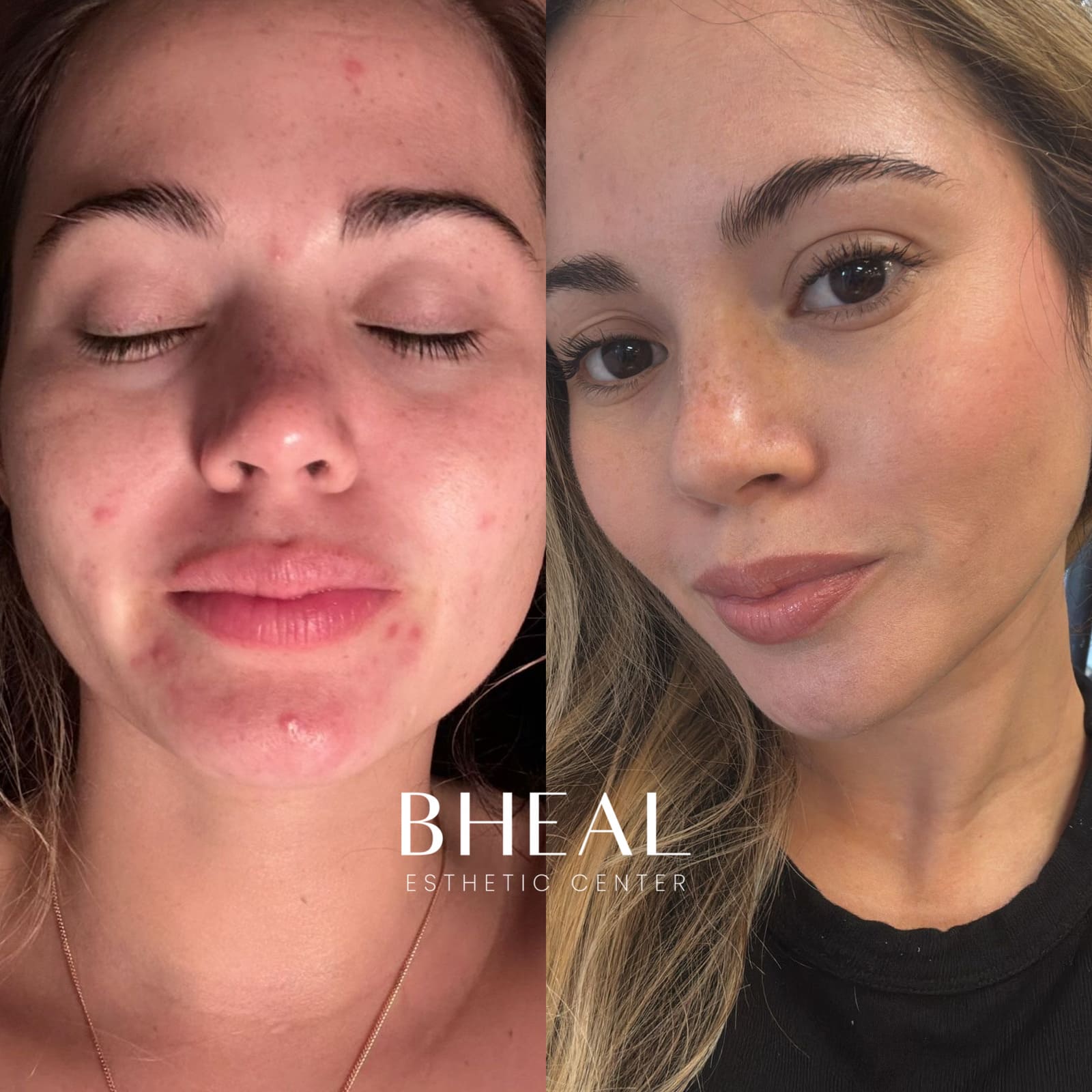 limpieza-facial-pro