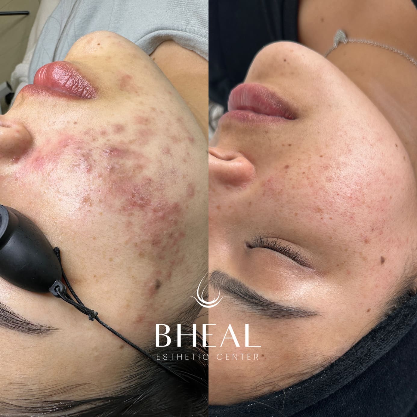post-acne-individual-1