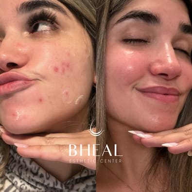 post-acne-individual-5